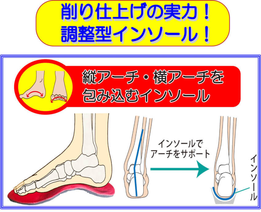 曲がった足を整えるインソール