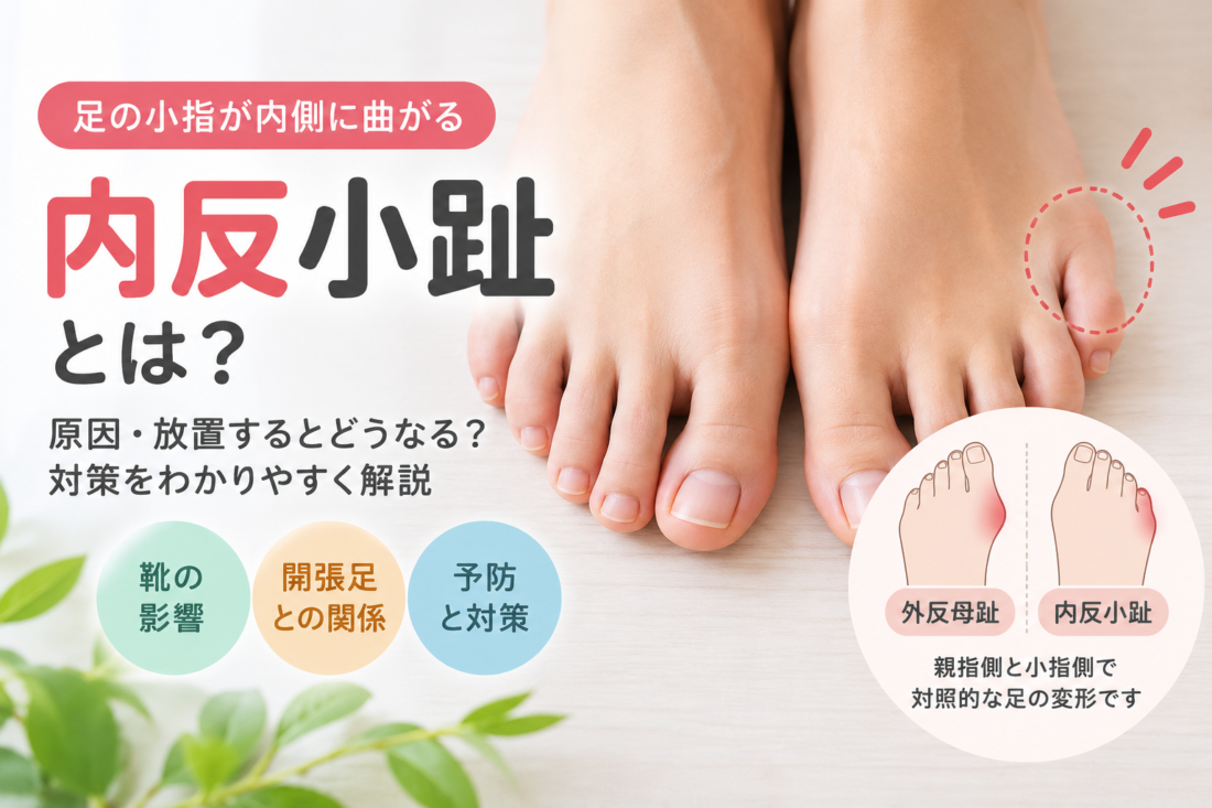 内反小趾で足の小指が内側に曲がる状態と原因・対策を解説